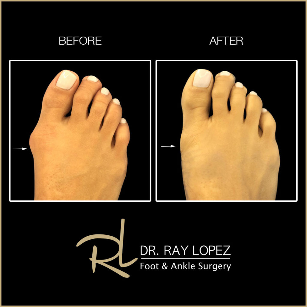 Beach Bunion Procedure™ Before and After 01