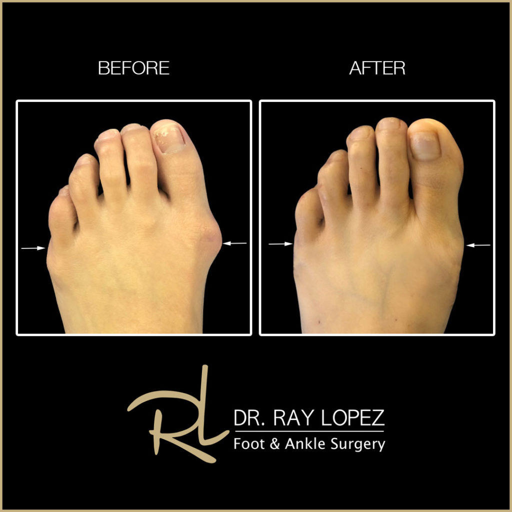 Beach Bunion Procedure™ Before and After 03