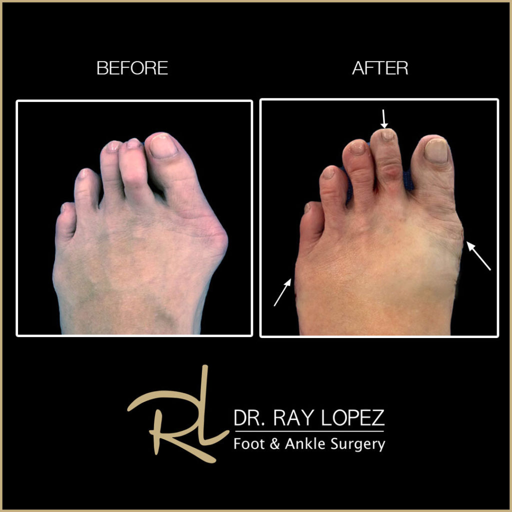 Beach Bunion Procedure™ Before and After 04