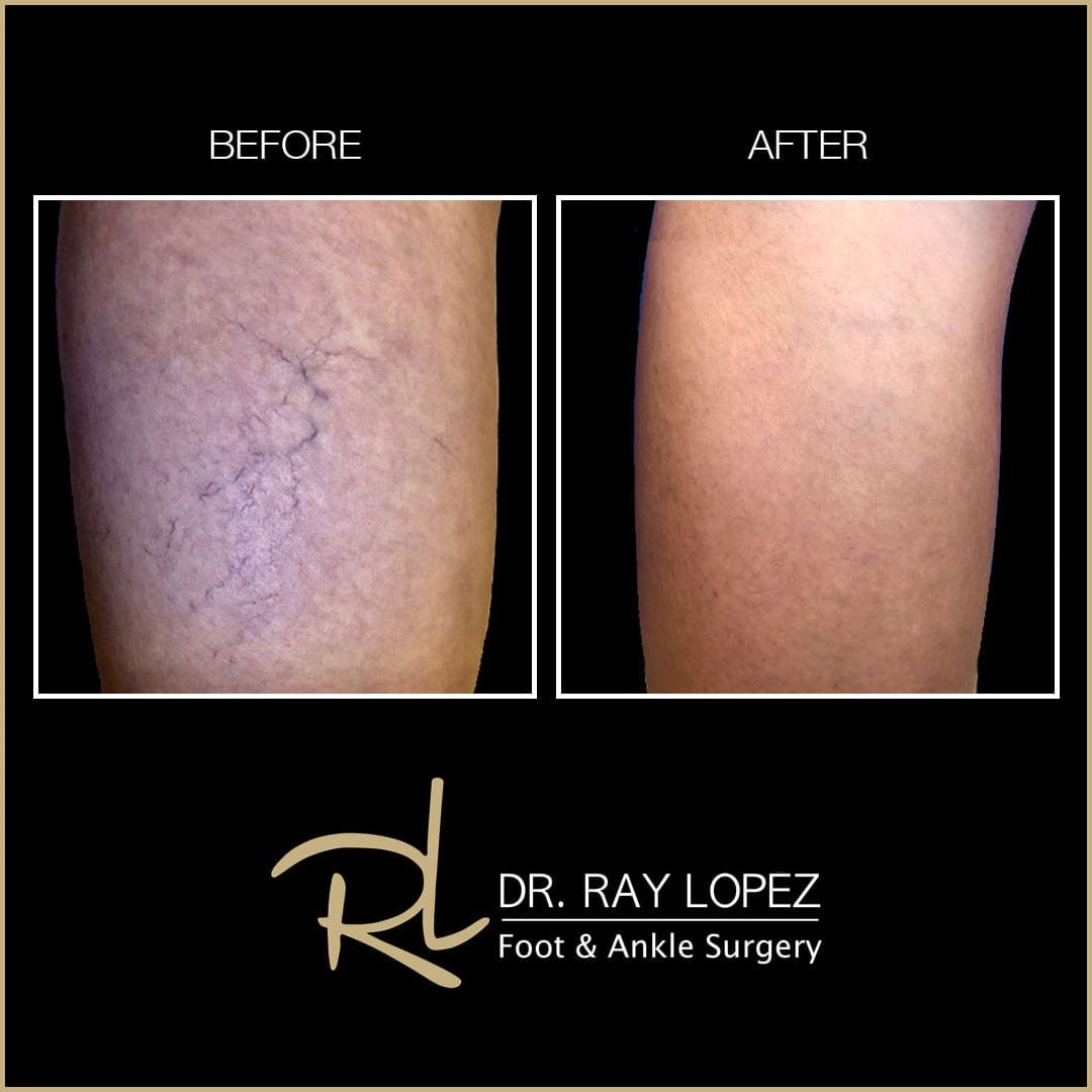 Spider Vein Treatment Before and After in Miami